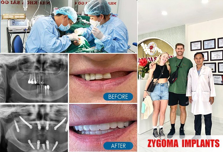 zygomatic implants before after