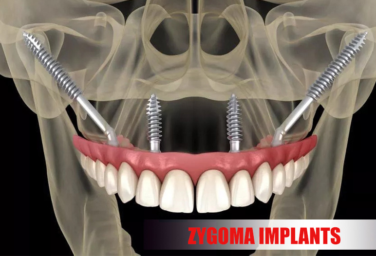 Zygoma Implants for Upper Jaw: Advantages, Benefits, Procedure, Cost ...