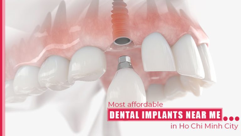Most affordable dental implants near me in Ho Chi Minh City, Vietnam