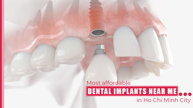 dental implant near me