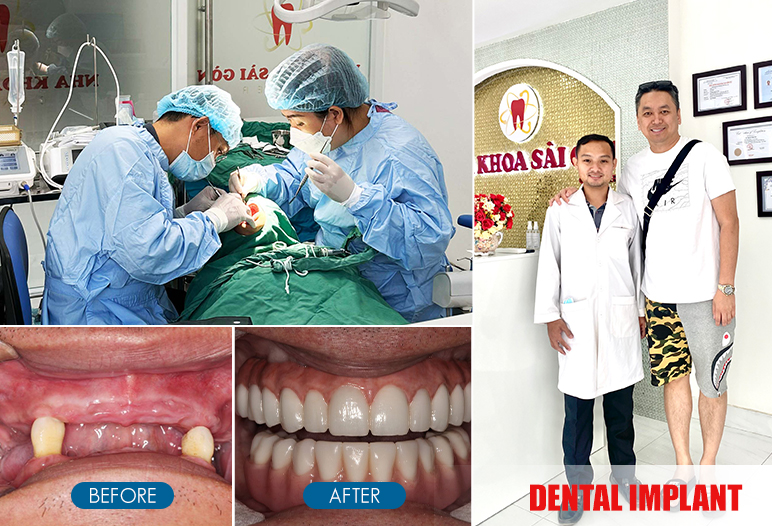 dental implant Reconstruction