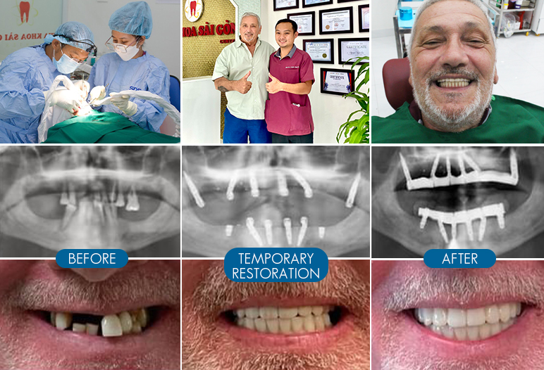 full mouth dental implant