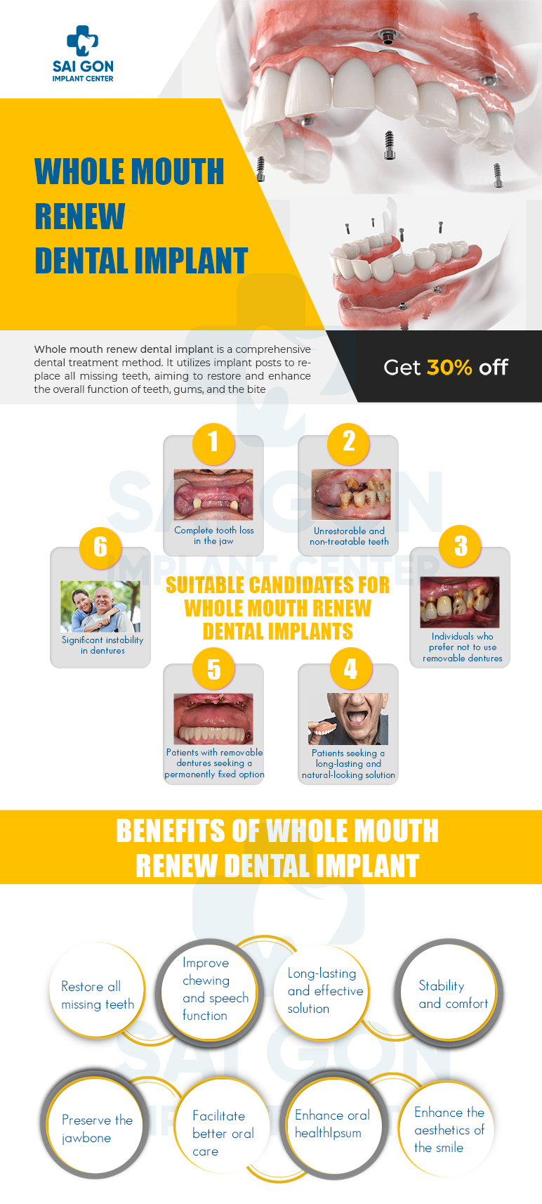 whole mouth reconstruction dental implant