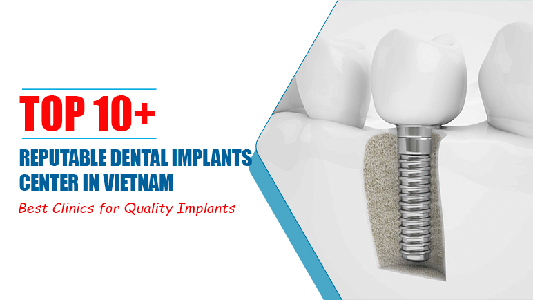 best dental implants center in ho chi minh city, vietnam