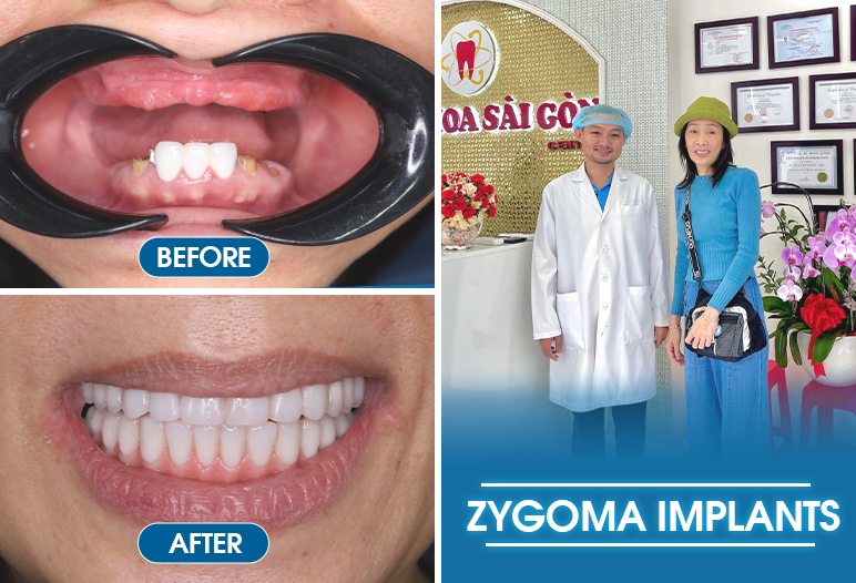 zygoma implants in vietnam