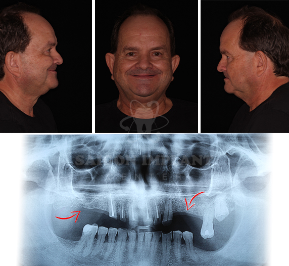 Severe tooth loss