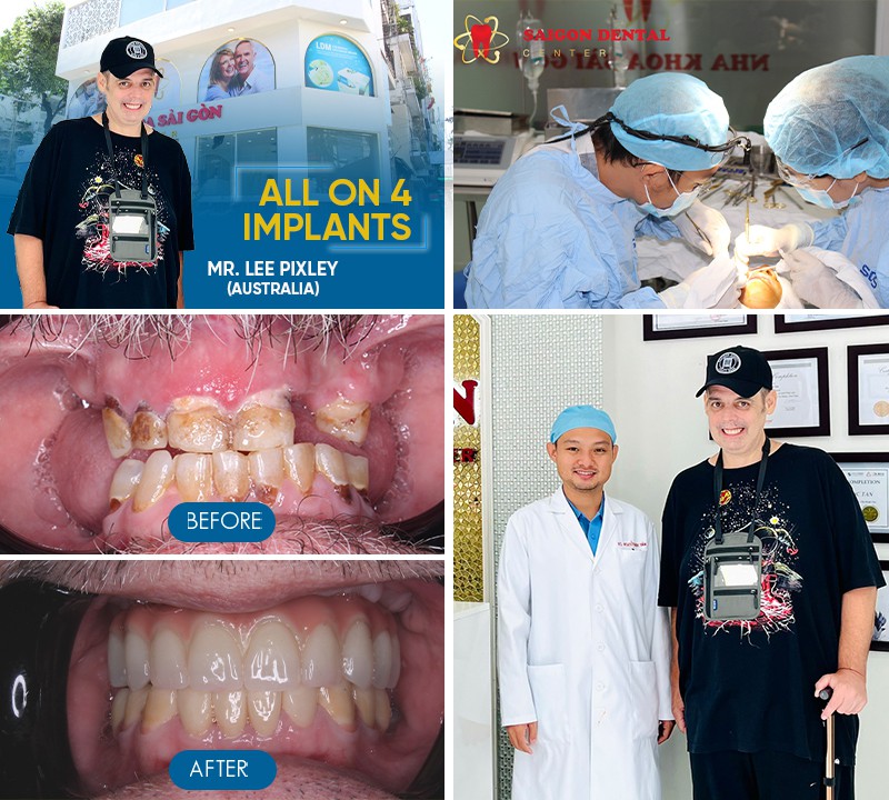 dental implants before and after image