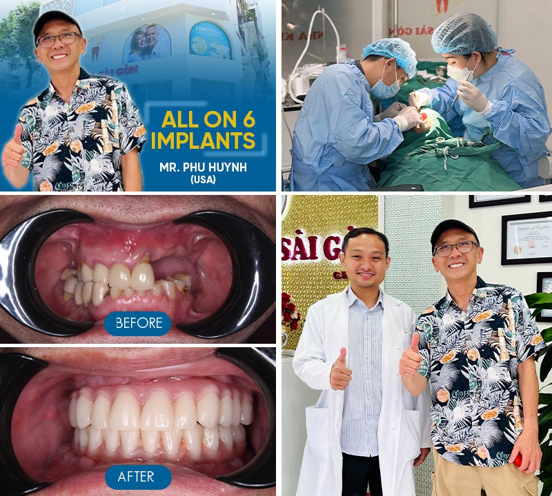 dental implants before and after 