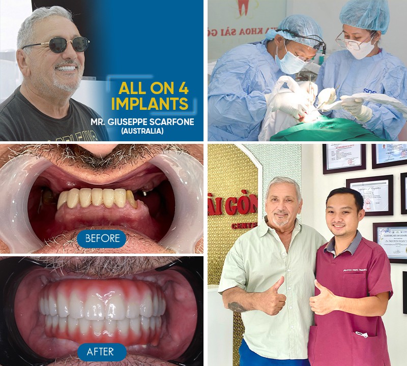 dental implants before and after 