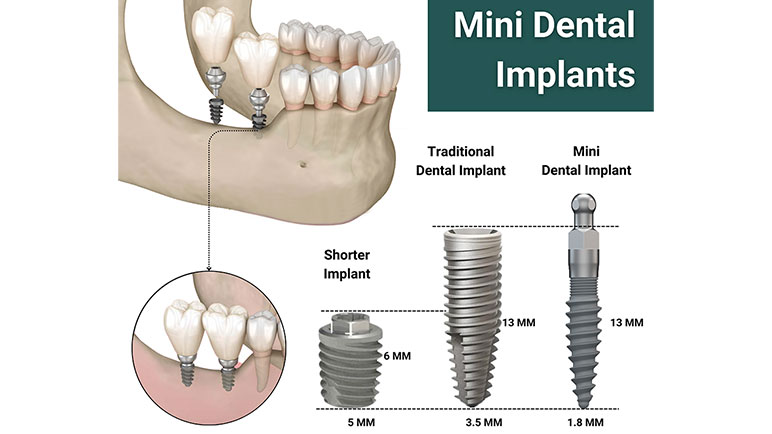 Best dental services near me with best dental implants