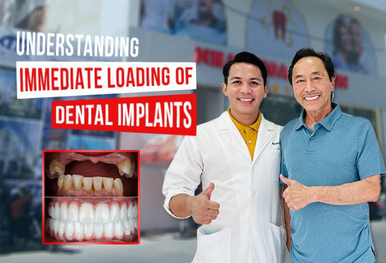 Dental Care - Understanding Immediate Loading Of Dental Implants ...