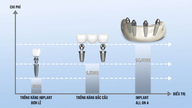 Dental Care - Understanding Immediate Loading of Dental Implants