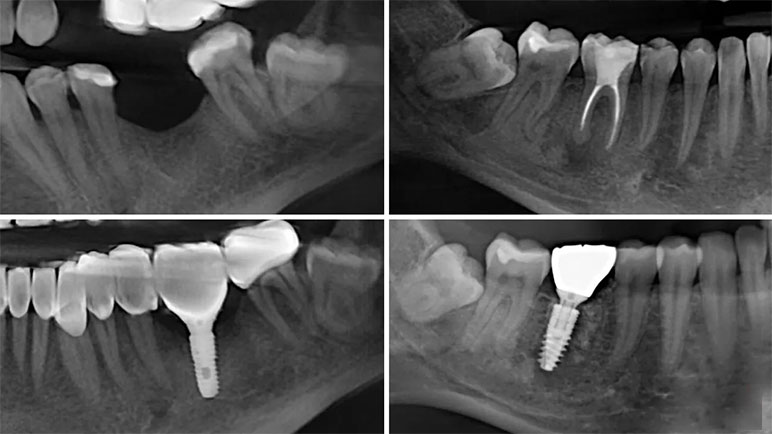 Dental Care - Understanding Immediate Loading of Dental Implants