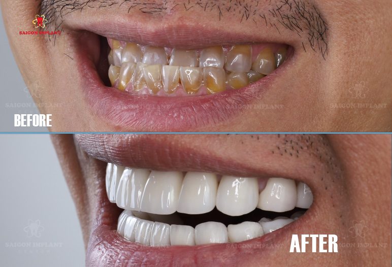 dental veneer in ho chi minh city