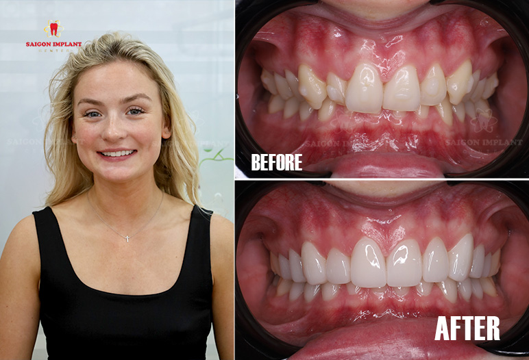 best dental veneer saigon