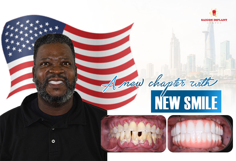 full mouth dental implant