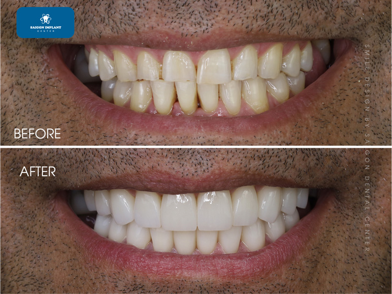 dental veneer in vietnam
