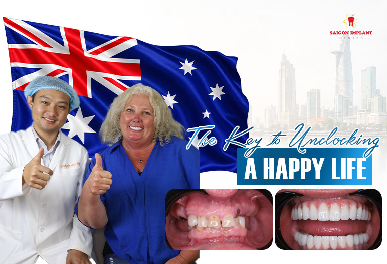 all-on-4 dental implants ho chi minh