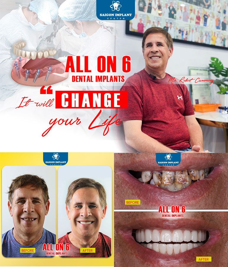 full mouth dental implants