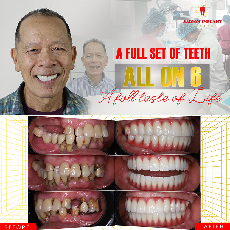 full mouth dental implants