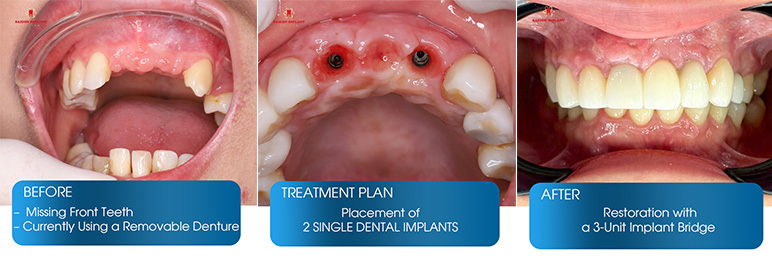 single dental implant vietnam 1