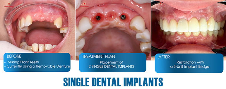 single dental implants in ho chi minh city