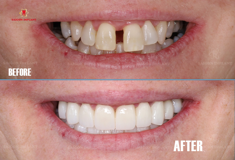 smile makeover in saigon