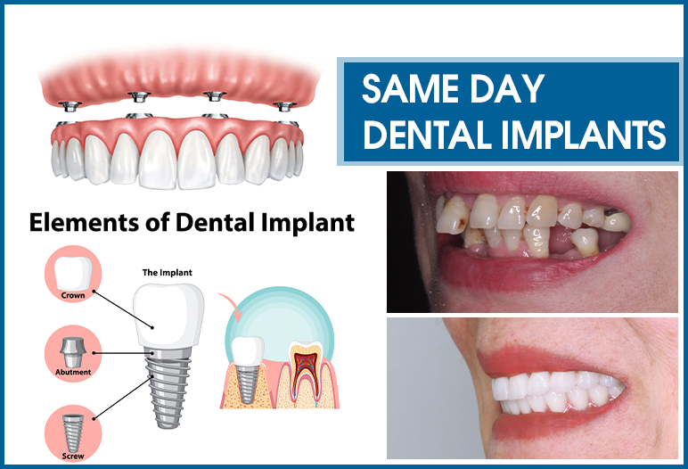 same day dental implants