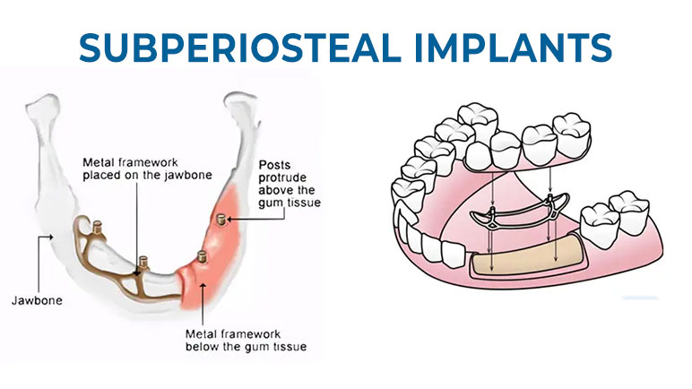 Since subperiosteal implants sit on top of the bone, they often require less invasive techniques