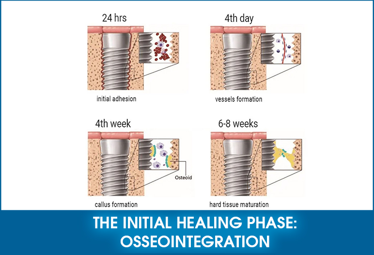 Osseointegration