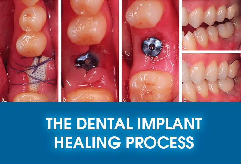 tooth implant healing