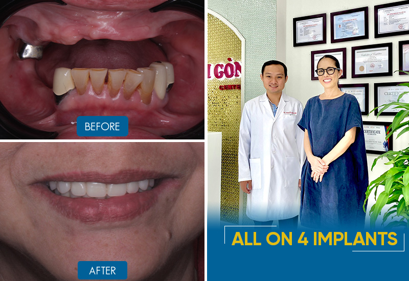 before and after all on 4 dental implants