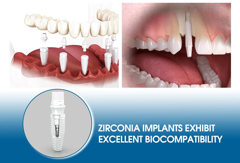 Zirconia implants are biocompatible