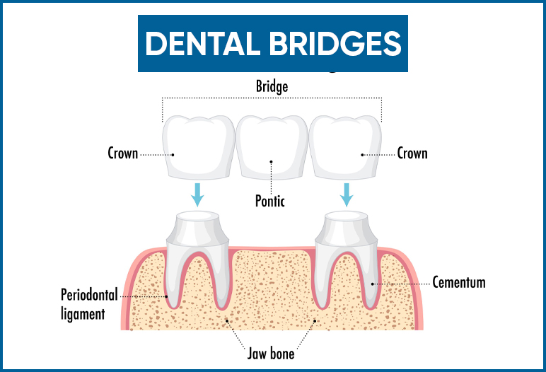 dental bridges