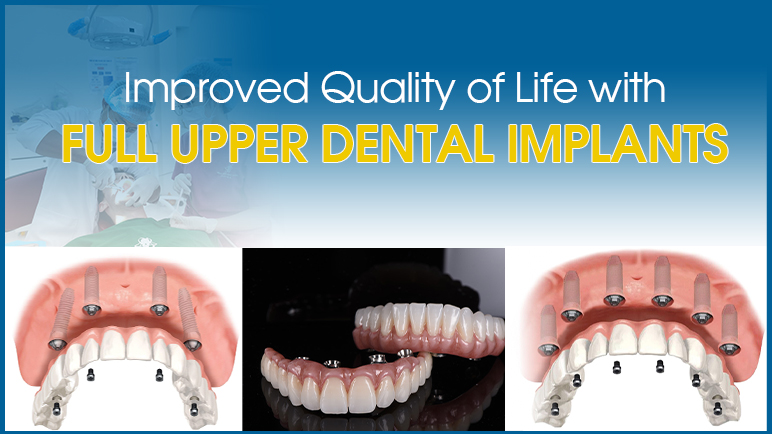 full upper dental implants