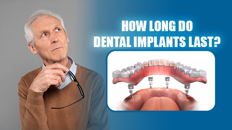 how long does a dental implant last