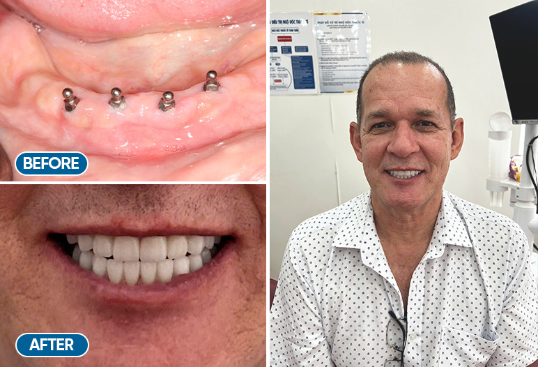 mini dental implants before and after image