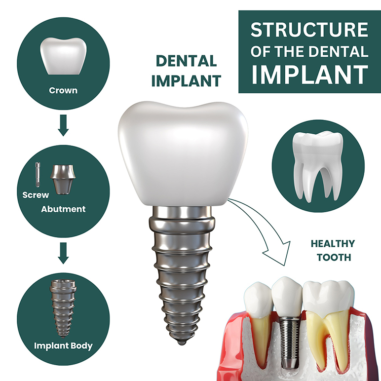 Once the implants have integrated with the jawbone, prosthetic teeth are fabricated and attached