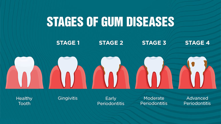 Can I Getting New Teeth? Exploring Options for a Healthy, Confident Smile