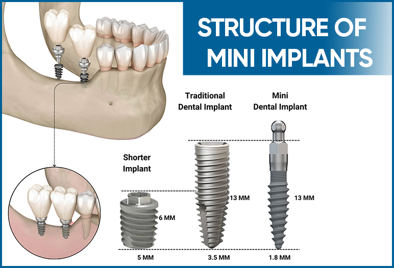 mini implants