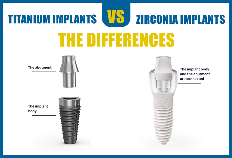 material dental implants