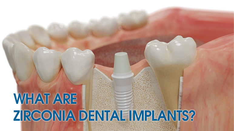 zirconia implants