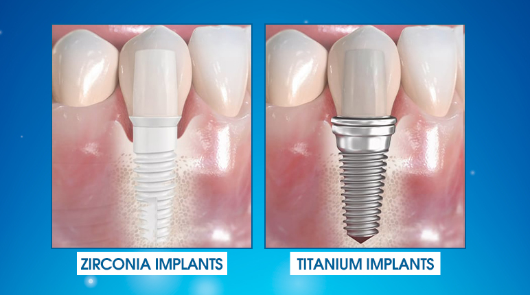 zirconia implants vs titanium implants