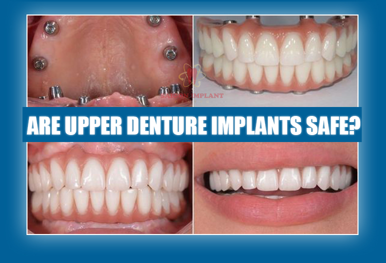 full upper dentures implants