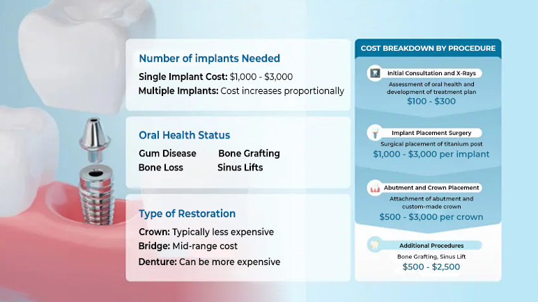 Cost considerations for dental implants