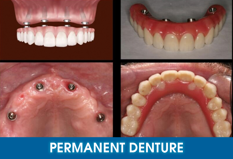 perment dentures