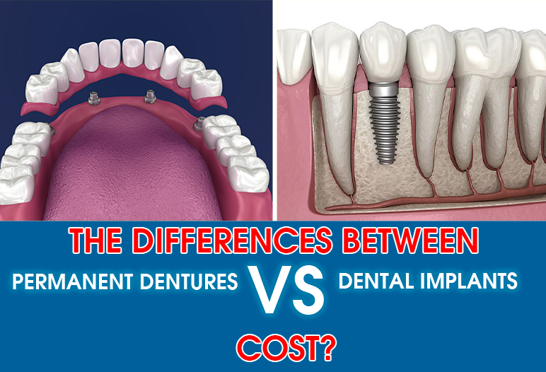 price of dentures vs implants