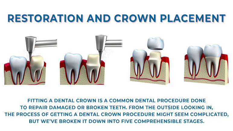 Phase 3: Restoration and crown placement