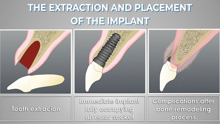 Phase 1: The extraction and placement of the implant