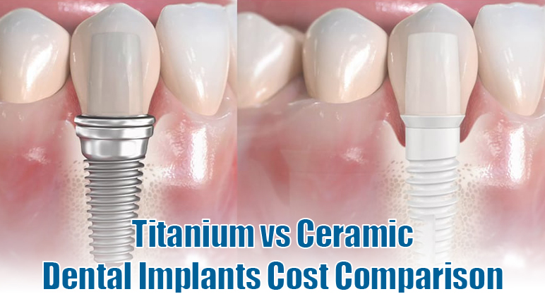 zirconia implants vs titanium cost